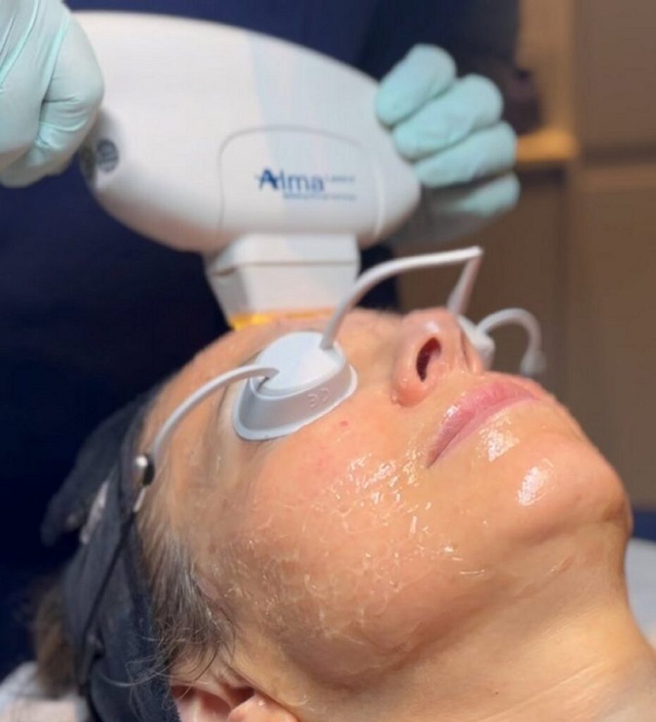 Harmony IPL handpiece by Alma Lasers being applied to patient's face